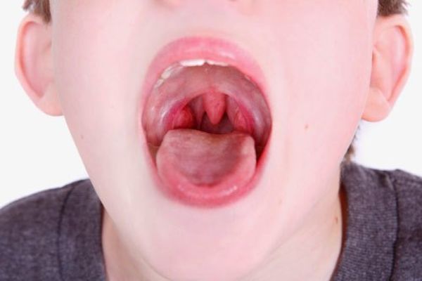 Tìm hiểu những nguyên nhân gây đau họng ở trẻ