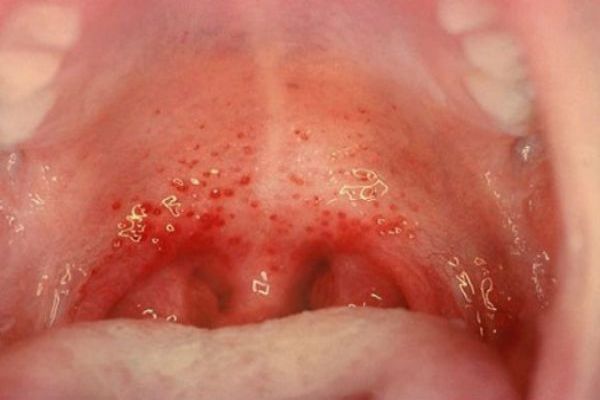 Đau rát cổ họng do viêm là dấu hiệu của bệnh gì?