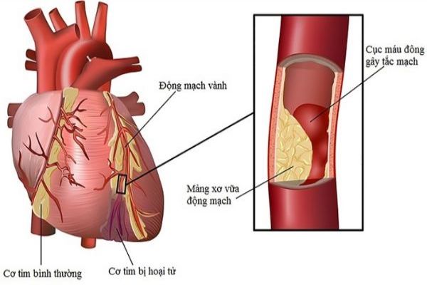 Các bệnh tim mạch điển hình