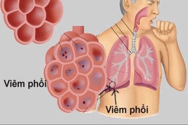 bệnh viêm phổi -nguy cơ xâm nhập vào Việt Nam
