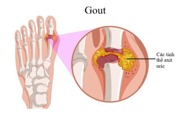 gout ,sản phẩm trị gout organic365